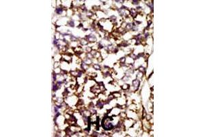 Formalin-fixed and paraffin-embedded human hepatocellular carcinoma tissue reacted with CDK4 polyclonal antibody  , which was peroxidase-conjugated to the secondary antibody, followed by AEC staining. (CDK4 anticorps  (AA 273-305))