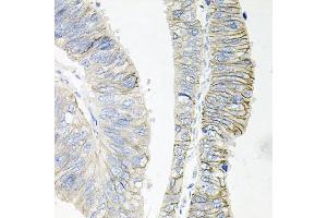 Immunohistochemistry of paraffin-embedded human colon carcinoma using B1 antibody (ABIN6127389, ABIN6137306, ABIN6137309 and ABIN6221475) at dilution of 1:100 (40x lens).