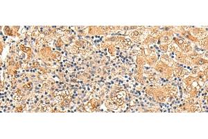 Immunohistochemistry of paraffin-embedded Human liver cancer tissue using GPD1L Polyclonal Antibody at dilution of 1:60(x200) (GPD1L anticorps)