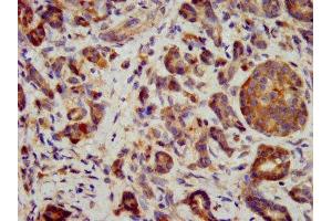 IHC image of ABIN7156494 diluted at 1:400 and staining in paraffin-embedded human pancreatic cancer performed on a Leica BondTM system.