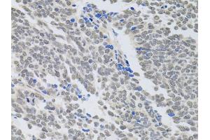 Immunohistochemistry of paraffin-embedded human lung cancer using PAX3 antibody (ABIN6290725) at dilution of 1:100 (40x lens). (Paired Box 3 anticorps)