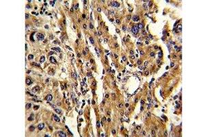 IHC analysis of FFPE human hepatocarcinoma stained with ABCG1 antibody