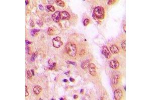 Immunohistochemical analysis of PSMA6 staining in human lung cancer formalin fixed paraffin embedded tissue section.