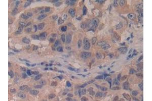 Detection of IFNb in Human Breast cancer Tissue using Polyclonal Antibody to Interferon Beta (IFNb)