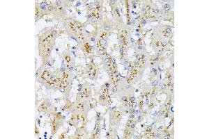 Immunohistochemistry of paraffin-embedded human colon carcinoma using GOLPH2 Rabbit pAb  at dilution of 1:100 (40x lens). (GOLM1 anticorps)