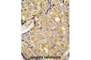Formalin-fixed and paraffin-embedded human prostate carcinoma tissue reacted with TRPM8 polyclonal antibody  , which was peroxidase-conjugated to the secondary antibody, followed by DAB staining. (TRPM8 anticorps  (Internal Region))