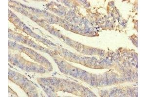 Immunohistochemistry of paraffin-embedded human endometrial cancer using ABIN7162936 at dilution of 1:100 (Peroxiredoxin 2 anticorps  (AA 2-65))