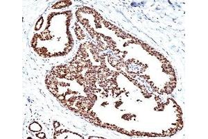 Formalin/paraffin human breast carcinoma stained with HSP60 antibody (HSPD1 anticorps)