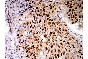 Immunohistochemical analysis of paraffin-embedded lung cancer tissues using LGALS1 mouse mAb with DAB staining.