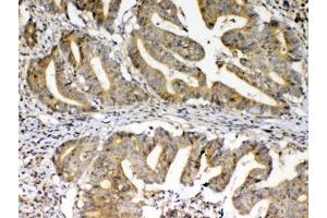 IHC testing of FFPE human colon cancer tissue with FZD3 antibody at 1ug/ml. (FZD3 anticorps)