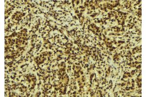 ABIN6274223 at 1/100 staining Human breast cancer tissue by IHC-P. (GTF2E2 anticorps  (Internal Region))
