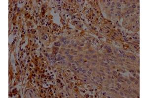 IHC image of ABIN7165087 diluted at 1:200 and staining in paraffin-embedded human cervical cancer performed on a Leica BondTM system. (AGO1 anticorps  (AA 251-400))