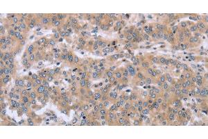 Immunohistochemistry of paraffin-embedded Human liver cancer using MAPRE3 Polyclonal Antibody at dilution of 1:30