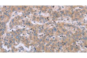 Immunohistochemistry of paraffin-embedded Human liver cancer using MAPRE3 Polyclonal Antibody at dilution of 1:30 (ECE1 anticorps)
