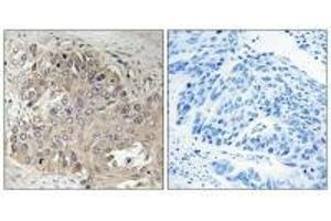 Immunohistochemistry analysis of paraffin-embedded human lung carcinoma tissue using SPTBN5 antibody. (SPTbN5 anticorps)