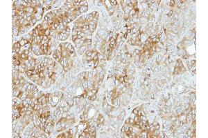IHC-P Image Immunohistochemical analysis of paraffin-embedded SW480 xenograft, using PFKL, antibody at 1:500 dilution.