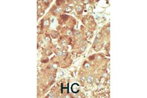 Formalin-fixed and paraffin-embedded human hepatocellular carcinoma tissue reacted with NLK polyclonal antibody  , which was peroxidase-conjugated to the secondary antibody, followed by DAB staining. (Nemo-Like Kinase anticorps  (C-Term))