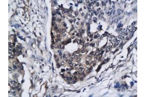 Formalin-fixed and paraffin embedded human breast cancer labeled with Anti SIRT3 Polyclonal Antibody, Unconjugated  followed by conjugation to the secondary antibody and DAB staining (SIRT3 anticorps  (AA 201-300))