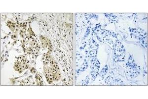 Immunohistochemistry analysis of paraffin-embedded human breast carcinoma, using TAGAP Antibody. (TAGAP anticorps  (AA 191-240))