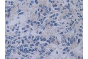 Detection of YARS in Human Prostate cancer Tissue using Polyclonal Antibody to Tyrosyl tRNA Synthetase (YARS)