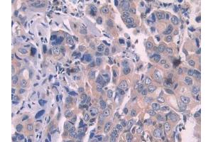 Used in DAB staining on fromalin fixed paraffin- embedded stomach cancer tissue (OAS1 anticorps  (AA 74-165))