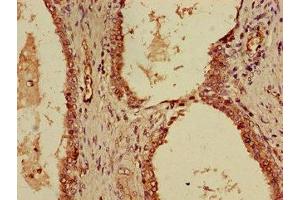 Immunohistochemistry of paraffin-embedded human prostate cancer using ABIN7156122 at dilution of 1:100 (KPNA4 anticorps  (AA 51-239))