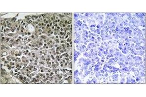 Immunohistochemistry analysis of paraffin-embedded human breast carcinoma tissue, using NFAT3 (Ab-676) Antibody. (NFATC4 anticorps  (AA 642-691))