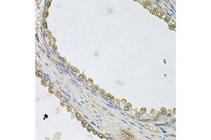 Immunohistochemistry of paraffin-embedded human prostate using MTERFD1 antibody (ABIN6003536) at dilution of 1/100 (40x lens). (MTERFD1 anticorps)