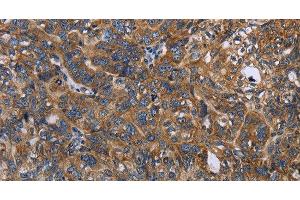 Immunohistochemistry of paraffin-embedded Human ovarian cancer tissue using LGALS2 Polyclonal Antibody at dilution 1:30 (Galectin 2 anticorps)