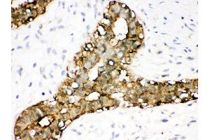 Anti- Annexin A3 Picoband antibody, IHC(P) IHC(P): Human Mammary Cancer Tissue