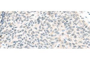 Immunohistochemistry of paraffin-embedded Human lung cancer tissue using ELOC Polyclonal Antibody at dilution 1:40 (TCEB1 anticorps)