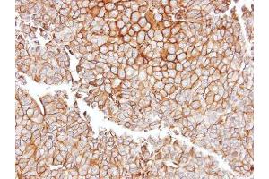 IHC-P Image Immunohistochemical analysis of paraffin-embedded PC13 xenograft, using GGT1, antibody at 1:100 dilution. (GGT1 anticorps)