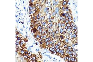 Immunohistochemistry of paraffin-embedded human lung cancer using Cathepsin B Rabbit mAb (ABIN7266148) at dilution of 1:100 (40x lens). (Cathepsin B anticorps)