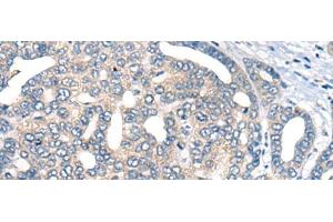 Immunohistochemistry of paraffin-embedded Human liver cancer tissue using AURKA Polyclonal Antibody at dilution of 1:40(x200) (Aurora A anticorps)