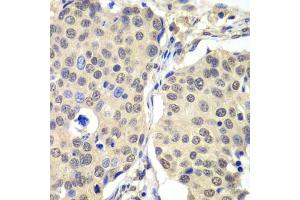 Immunohistochemistry of paraffin-embedded human lung cancer using CCNC antibody. (Cyclin C anticorps)