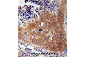 FBXW8 Antibody (Center) immunohistochemistry analysis in formalin fixed and paraffin embedded human lung carcinoma followed by peroxidase conjugation of the secondary antibody and DAB staining. (FBXW8 anticorps  (Middle Region))