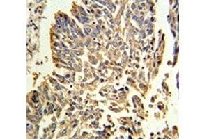 HSP27 antibody IHC analysis in formalin fixed and paraffin embedded human lung carcinoma.