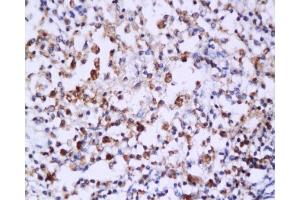 Formalin-fixed and paraffin embedded: human endometrium carcinoma labeled with Anti-Caspase-6 Polyclonal Antibody , Unconjugated 1:200 followed by conjugation to the secondary antibody and DAB staining (Caspase 6 anticorps  (AA 151-250))