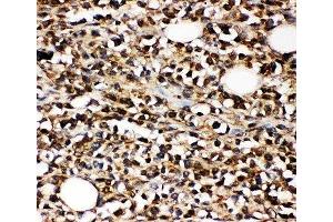 IHC-P: CD10 antibody testing of human B-lymphocyte cancer tissue (MME anticorps  (AA 52-750))