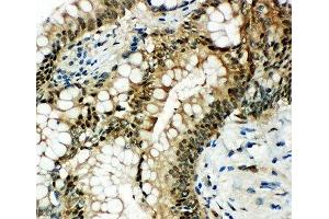 IHC-P: HSP70 antibody testing of human intestinal cancer tissue