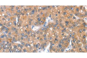 Immunohistochemistry of paraffin-embedded Human liver cancer tissue using CD238 Polyclonal Antibody at dilution 1:40 (KEL anticorps)