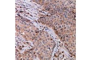 Immunohistochemical analysis of VPS54 staining in human breast cancer formalin fixed paraffin embedded tissue section. (VPS54 anticorps)