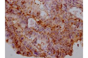 IHC image of ABIN7143869 diluted at 1:500 and staining in paraffin-embedded human colon cancer tissue performed on a Leica BondTM system.