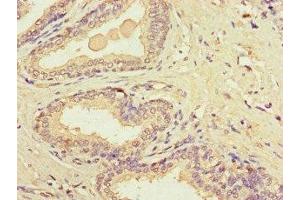 Immunohistochemistry of paraffin-embedded human prostate cancer using ABIN7149154 at dilution of 1:100