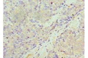 Immunohistochemistry of paraffin-embedded human colon cancer using ABIN7170948 at dilution of 1:100 (SULT1A1 anticorps  (AA 1-295))
