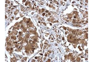 IHC-P Image EPS8 antibody [C3], C-term detects EPS8 protein at cytosol and nucleus on human breast carcinoma by immunohistochemical analysis. (EPS8 anticorps  (C-Term))