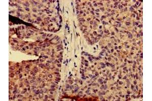 Immunohistochemistry of paraffin-embedded human ovarian cancer using ABIN7146536 at dilution of 1:100 (Calpain 14 anticorps  (AA 68-366))