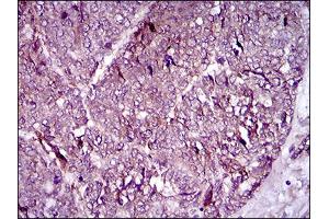 Immunohistochemical analysis of paraffin-embedded esophageal cancer tissues using MCAM mouse mAb with DAB staining. (MCAM anticorps  (AA 84-189))