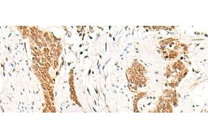 Immunohistochemistry of paraffin-embedded Human esophagus cancer tissue using HOXC13 Polyclonal Antibody at dilution of 1:60(x200) (HOXC13 anticorps)