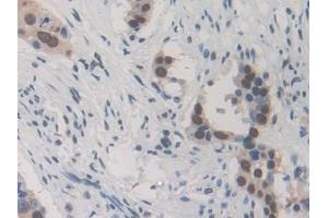 Detection of HNRNPA1 in Human Lung cancer Tissue using Polyclonal Antibody to Heterogeneous Nuclear Ribonucleoprotein A1 (HNRNPA1)